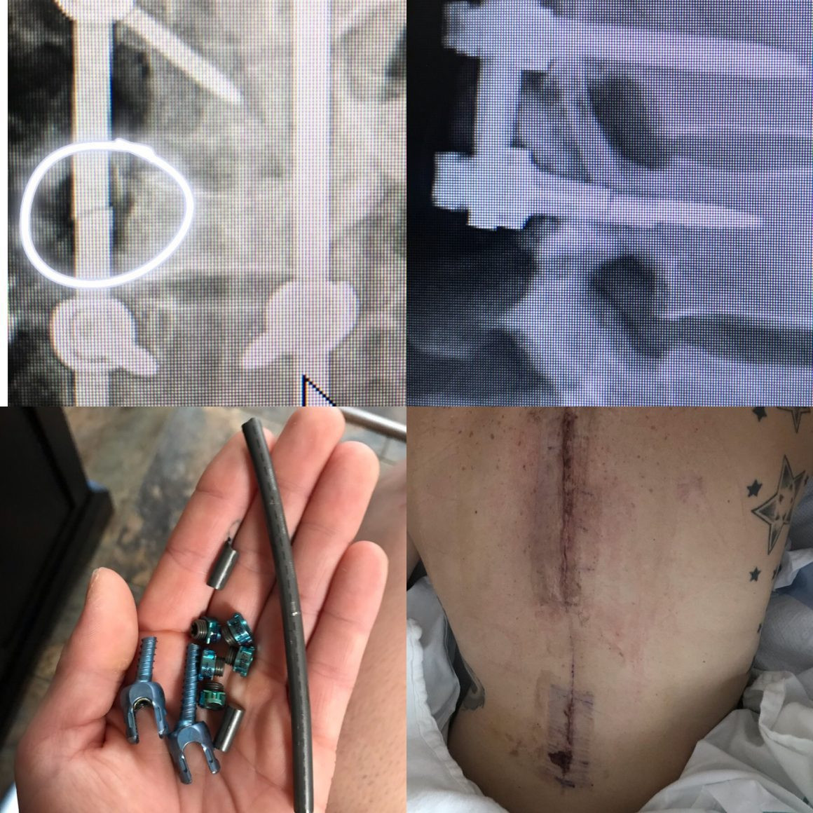 top left:broken rod top right: broken screw, bottom left: the hardware that was removed bottom right: the incision